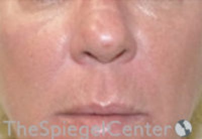 Nasolabial Fold Filler Before & After Gallery - Patient 308341 - Image 2