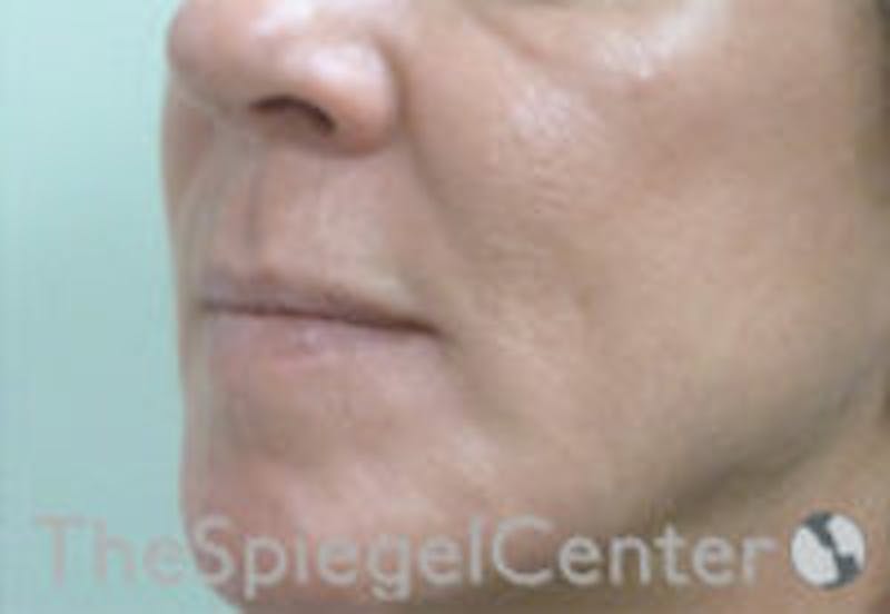 Nasolabial Fold Filler Before & After Gallery - Patient 308341 - Image 3