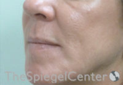Nasolabial Fold Filler Before & After Gallery - Patient 308341 - Image 3