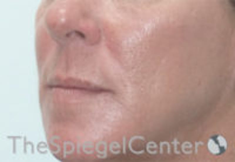 Nasolabial Fold Filler Before & After Gallery - Patient 308341 - Image 4