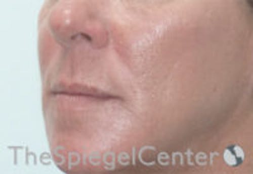 Nasolabial Fold Filler Before & After Gallery - Patient 308341 - Image 4