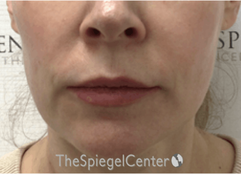 Nasolabial Fold Filler Before & After Gallery - Patient 331710 - Image 1