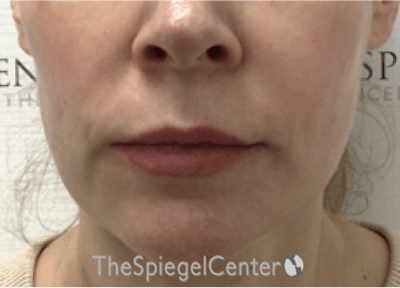 Nasolabial Fold Filler Before & After Gallery - Patient 331710 - Image 1