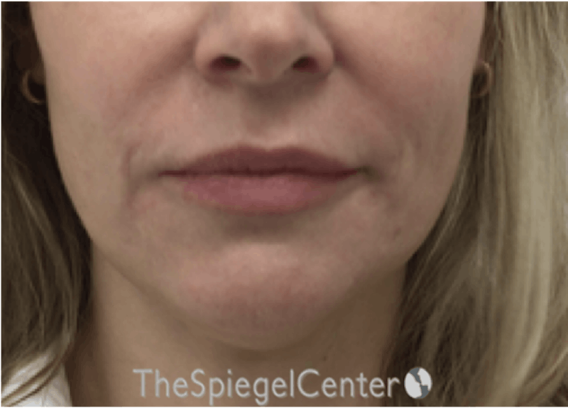 Nasolabial Fold Filler Before & After Gallery - Patient 331710 - Image 2