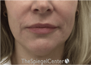 Nasolabial Fold Filler Before & After Gallery - Patient 331710 - Image 2