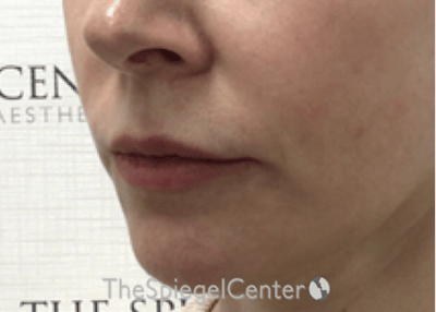 Nasolabial Fold Filler Before & After Gallery - Patient 331710 - Image 3