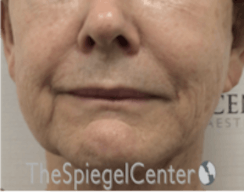 Nasolabial Fold Filler Before & After Gallery - Patient 182813 - Image 1