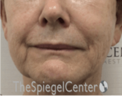 Nasolabial Fold Filler Before & After Gallery - Patient 182813 - Image 1