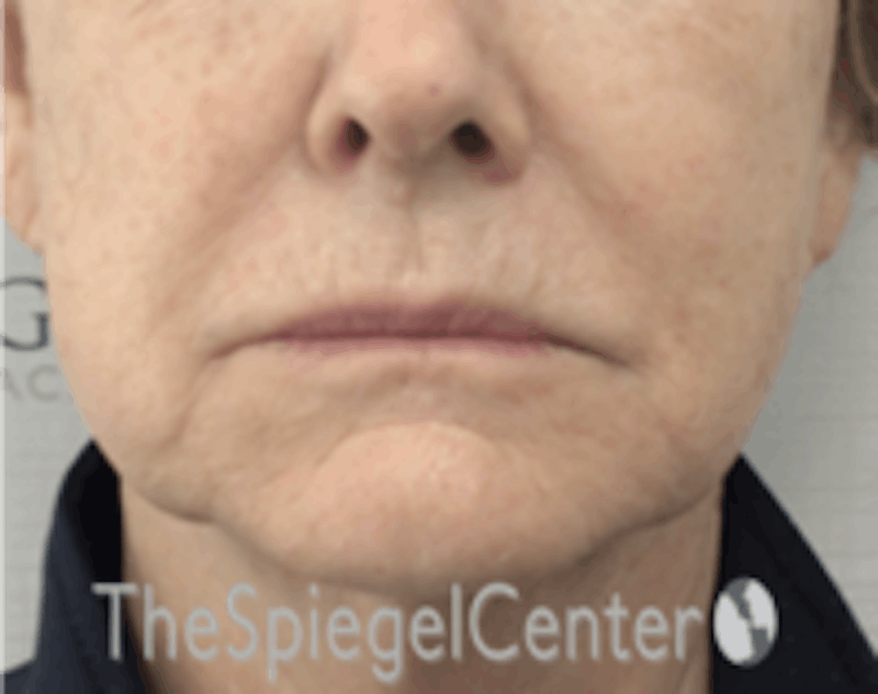 Nasolabial Fold Filler Before & After Gallery - Patient 182813 - Image 2
