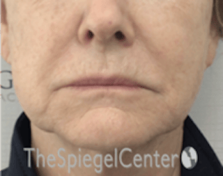 Nasolabial Fold Filler Before & After Gallery - Patient 182813 - Image 2