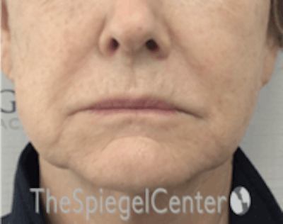 Nasolabial Fold Filler Before & After Gallery - Patient 182813 - Image 2