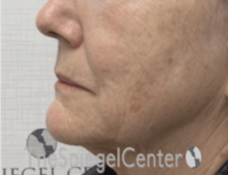 Nasolabial Fold Filler Before & After Gallery - Patient 182813 - Image 3