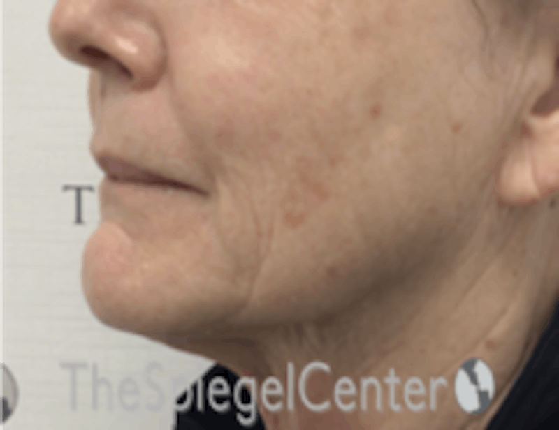 Nasolabial Fold Filler Before & After Gallery - Patient 182813 - Image 4