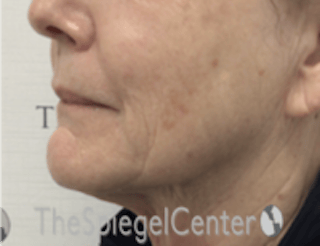 Nasolabial Fold Filler Before & After Gallery - Patient 182813 - Image 4