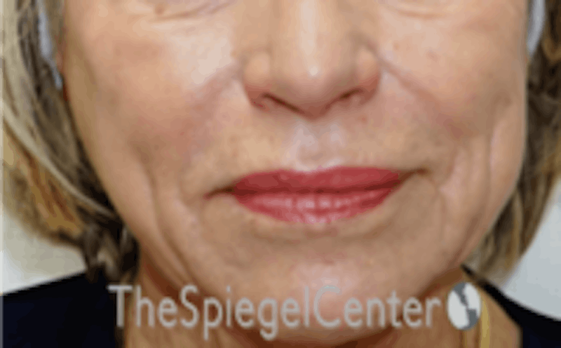 Nasolabial Fold Filler Before & After Gallery - Patient 504318 - Image 1