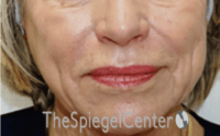 Nasolabial Fold Filler Before & After Gallery - Patient 504318 - Image 1