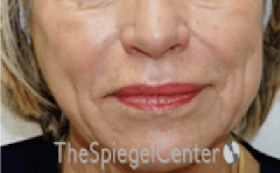 Nasolabial Fold Filler Before & After Gallery - Patient 504318 - Image 1