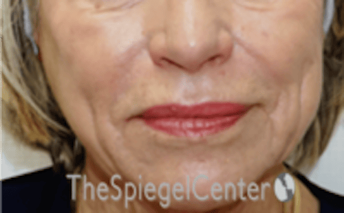 Nasolabial Fold Filler Before & After Gallery - Patient 504318 - Image 1