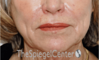 Nasolabial Fold Filler Before & After Gallery - Patient 504318 - Image 2
