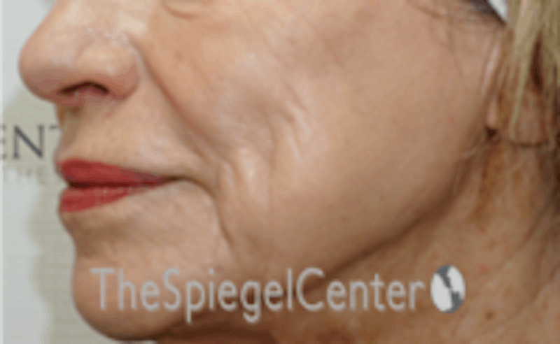 Nasolabial Fold Filler Before & After Gallery - Patient 504318 - Image 3