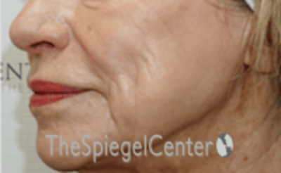 Nasolabial Fold Filler Before & After Gallery - Patient 504318 - Image 3