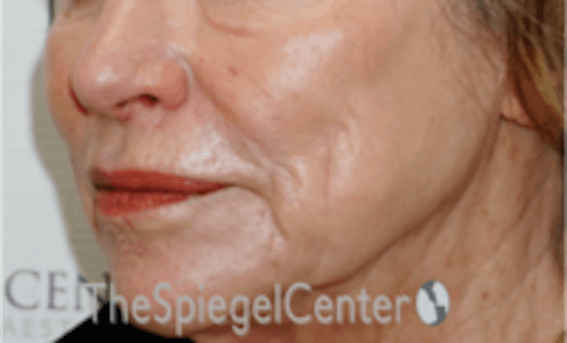 Nasolabial Fold Filler Before & After Gallery - Patient 504318 - Image 4