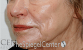 Nasolabial Fold Filler Before & After Gallery - Patient 504318 - Image 4
