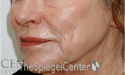 Nasolabial Fold Filler Before & After Gallery - Patient 504318 - Image 4