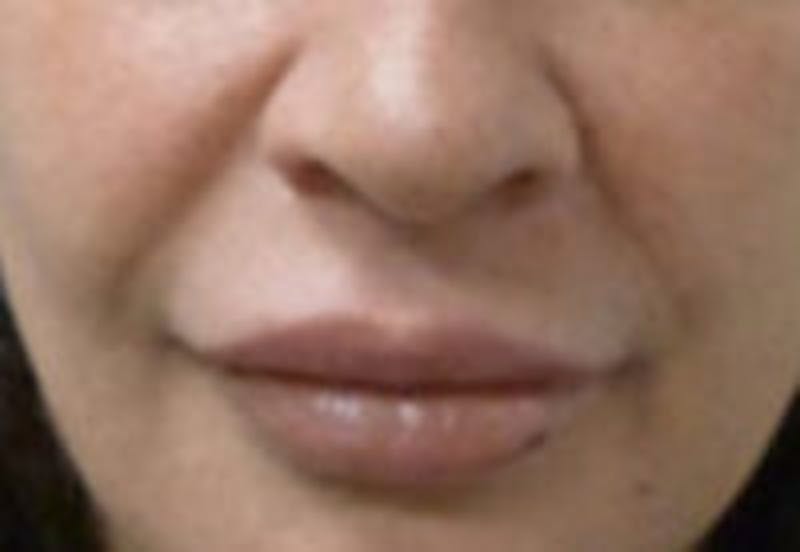 Nasolabial Fold Filler Before & After Gallery - Patient 381785 - Image 1
