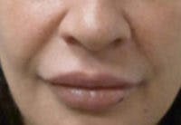 Nasolabial Fold Filler Before & After Gallery - Patient 381785 - Image 1