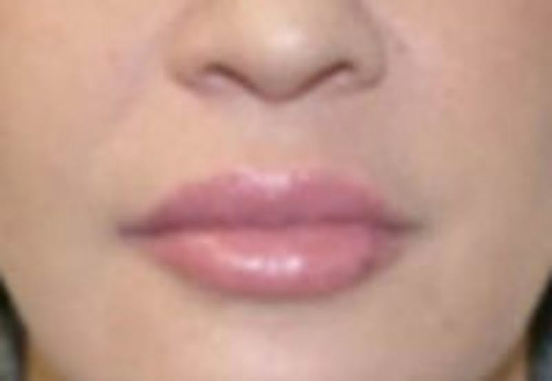 Nasolabial Fold Filler Before & After Gallery - Patient 381785 - Image 2