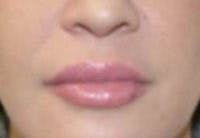 Nasolabial Fold Filler Before & After Gallery - Patient 381785 - Image 2