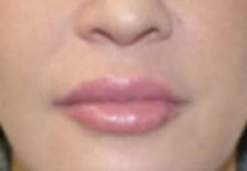 Nasolabial Fold Filler Before & After Gallery - Patient 381785 - Image 2