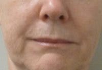 Nasolabial Fold Filler Before & After Gallery - Patient 199207 - Image 1