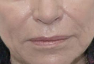 Nasolabial Fold Filler Before & After Gallery - Patient 936241 - Image 2
