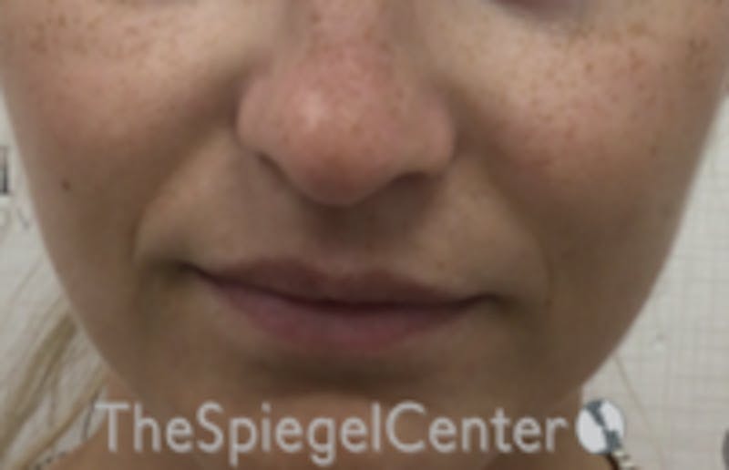 Nasolabial Fold Filler Before & After Gallery - Patient 278911 - Image 1