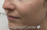 Nasolabial Fold Filler Before & After Gallery - Patient 278911 - Image 3