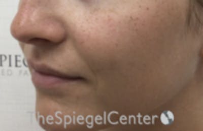 Nasolabial Fold Filler Before & After Gallery - Patient 278911 - Image 3