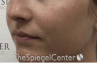Nasolabial Fold Filler Before & After Gallery - Patient 278911 - Image 4