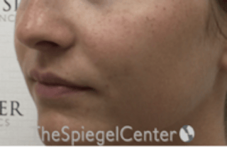 Nasolabial Fold Filler Before & After Gallery - Patient 278911 - Image 4