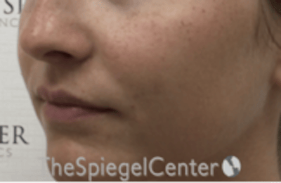 Nasolabial Fold Filler Before & After Gallery - Patient 278911 - Image 4