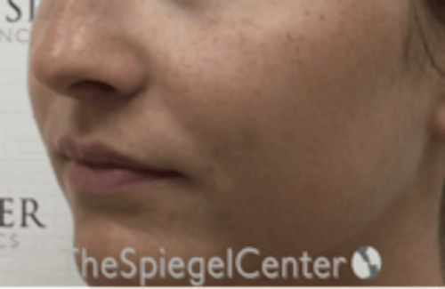 Nasolabial Fold Filler Before & After Gallery - Patient 278911 - Image 4