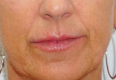 Nasolabial Fold Filler Before & After Gallery - Patient 332921 - Image 1