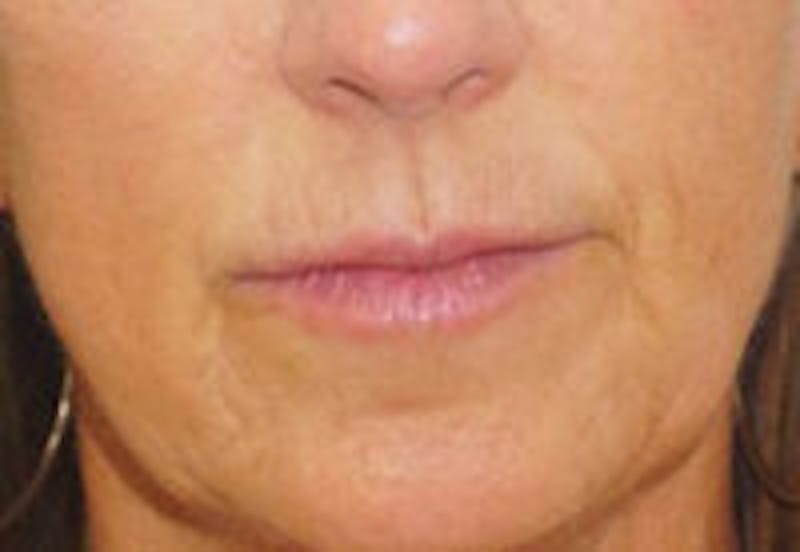 Nasolabial Fold Filler Before & After Gallery - Patient 332921 - Image 2