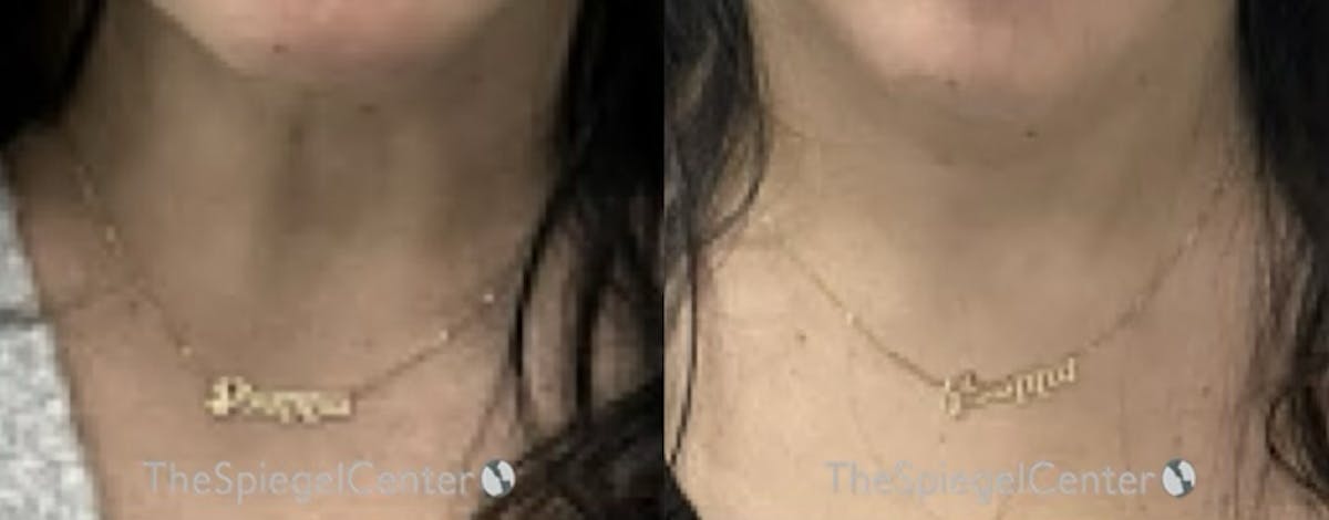 Neck Botox Before & After Gallery - Patient 361109 - Image 1