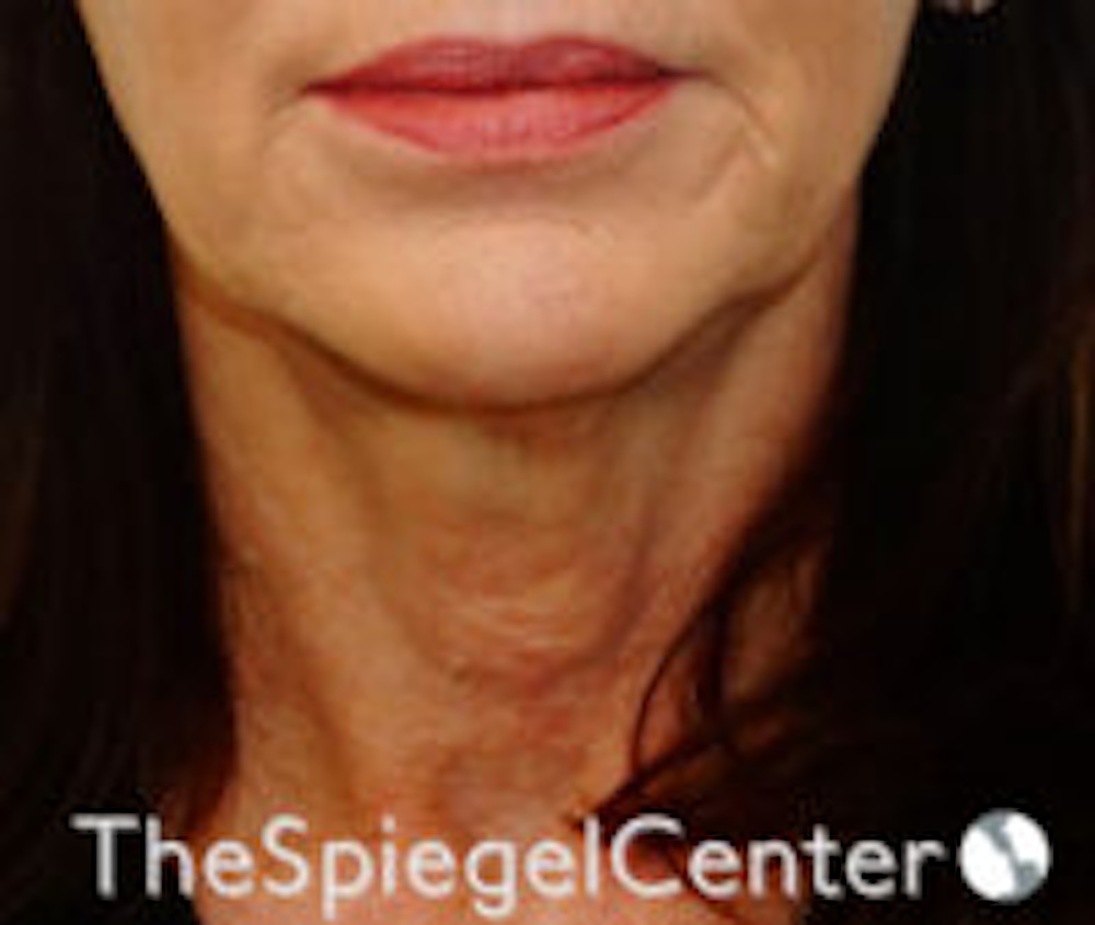 neck botox before and after