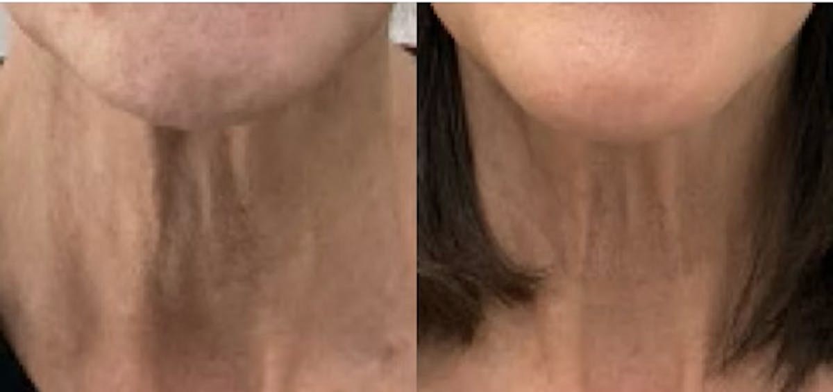 Neck Botox Before & After Gallery - Patient 245682 - Image 1