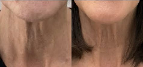 Neck Botox Before & After Gallery - Patient 245682 - Image 1