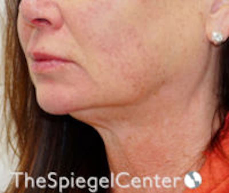 Neck Botox Before & After Gallery - Patient 377893 - Image 1