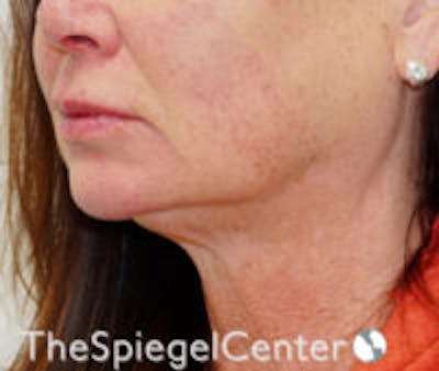 Neck Botox Before & After Gallery - Patient 377893 - Image 1